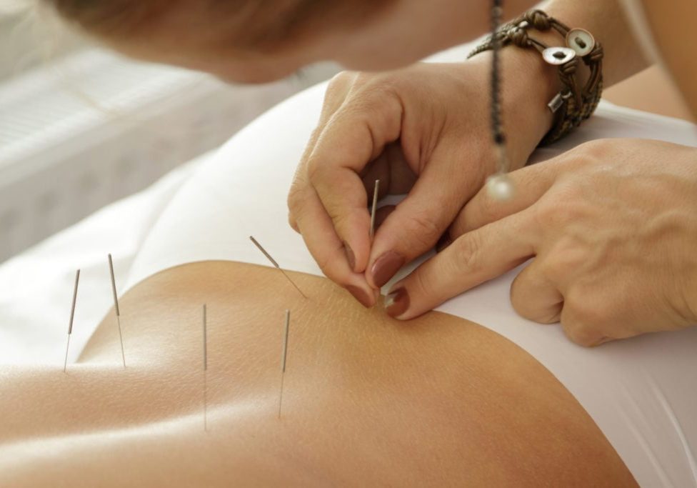 Alternative medicine. Master is injecting steel needles during procedure of acupuncture therapy.