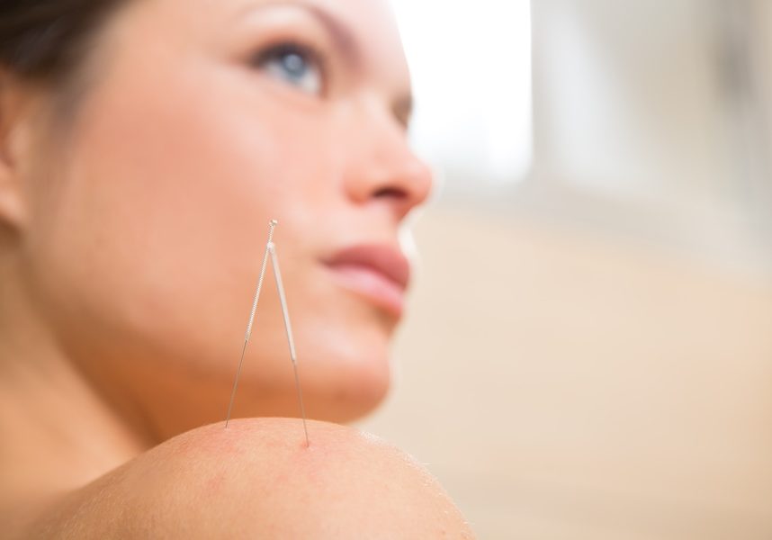 Acupuncture needle pricking on woman shoulder therapy closeup