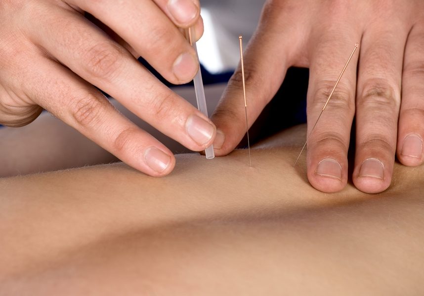 Adult male physiotherapist is doing acupuncture on the back of a female patient. Patient is lying down on a bed and is covered with royal blue towels.