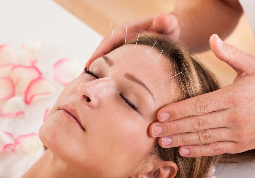 Woman undergoing acupuncture treatment with a line of fine needles inserted into the skin of her forehead